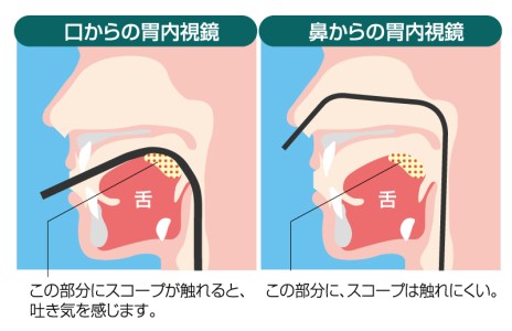 特徴1 負担が少ない経鼻内視鏡検査を行います
