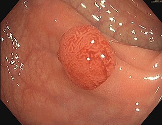 大腸内視鏡で観察された管状腺腫のポリープ。検査で見つかる主な病変の実例を示し、内視鏡では形状や大きさを直接確認できる点を理解しやすくします。