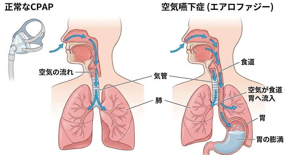 CPAP使用時に空気が気管ではなく食道へ流れ込み、胃が膨らむ呑気症（エアロファジア）のメカニズム図解
