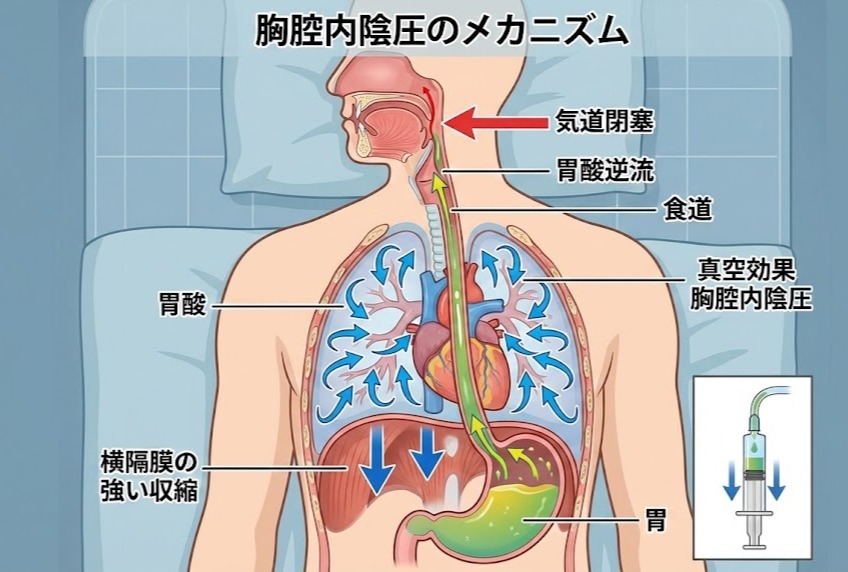 閉塞性睡眠時無呼吸による強い吸い込み（陰圧）が、注射器のように胃酸を食道へ吸い上げるメカニズムの図解