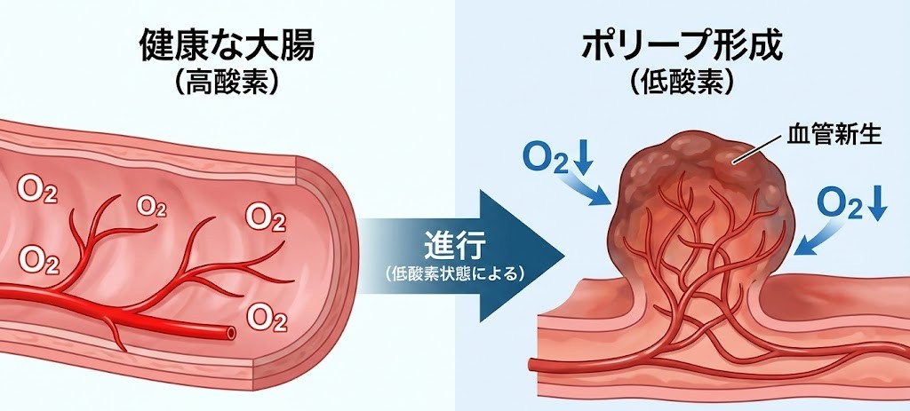 低酸素状態が引き金となり大腸ポリープや血管新生が進行するリスクの図解