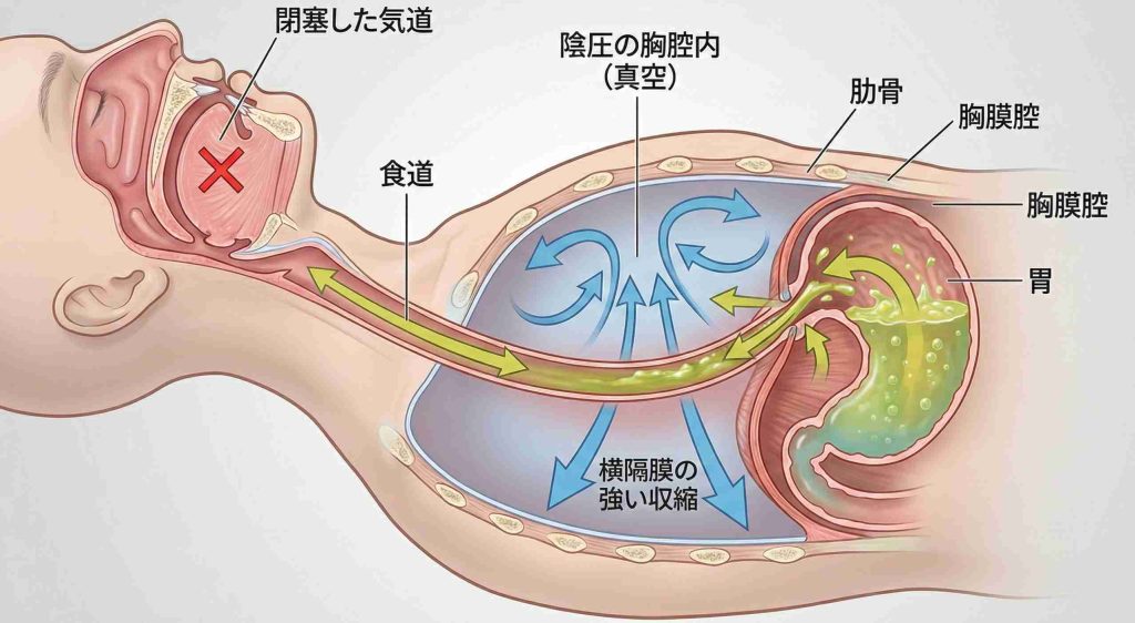 呼吸停止時の強い陰圧によって胃酸が食道へ吸い上げられるメカニズム図
