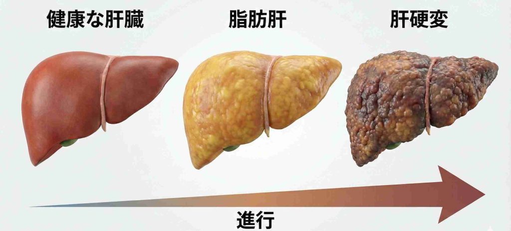 健康な肝臓から脂肪肝、そして肝硬変へと進行していく様子の比較イラスト