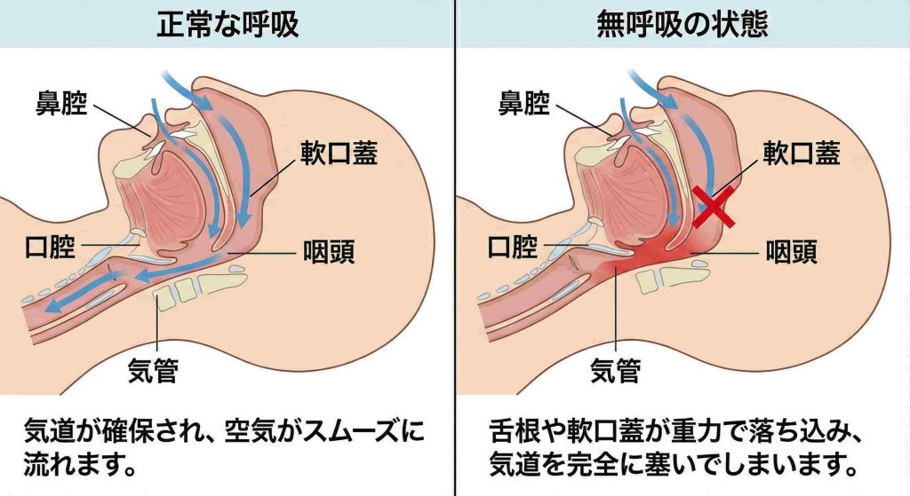 正常な呼吸時の気道と、睡眠時無呼吸症候群で舌が落ち込み気道が閉塞している様子の断面比較図