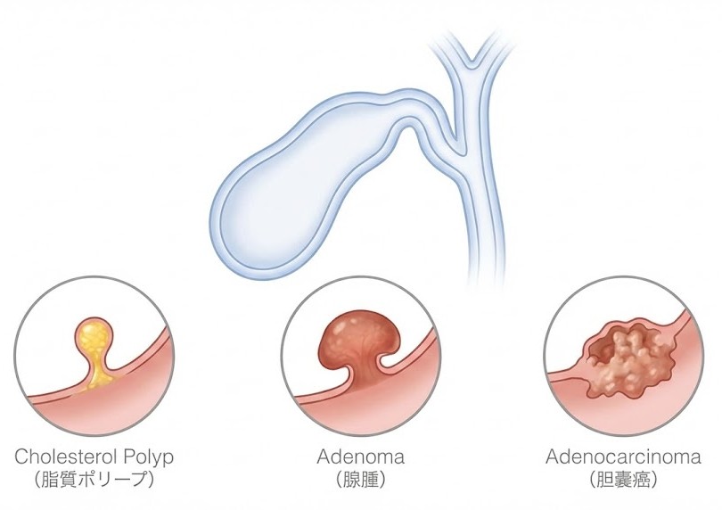コレステロールポリープ・腺腫・胆嚢癌の違いを示す図解