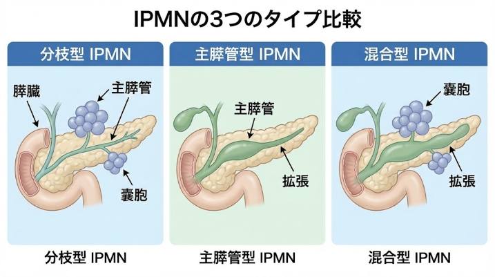 IPMNの分枝型・主膵管型・混合型を比較したイラスト