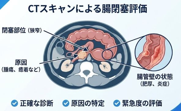 CT検査で確認する腸閉塞の評価ポイント(閉塞部位、原因、腸管壁の状態など)