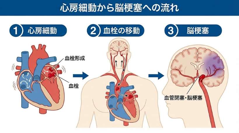 心房細動により心臓内で形成された血栓が脳へ移動して脳梗塞を起こす過程の図解