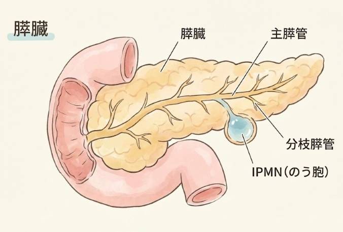 膵臓の分枝膵管にできたIPMN(のう胞)の位置を示すイラスト